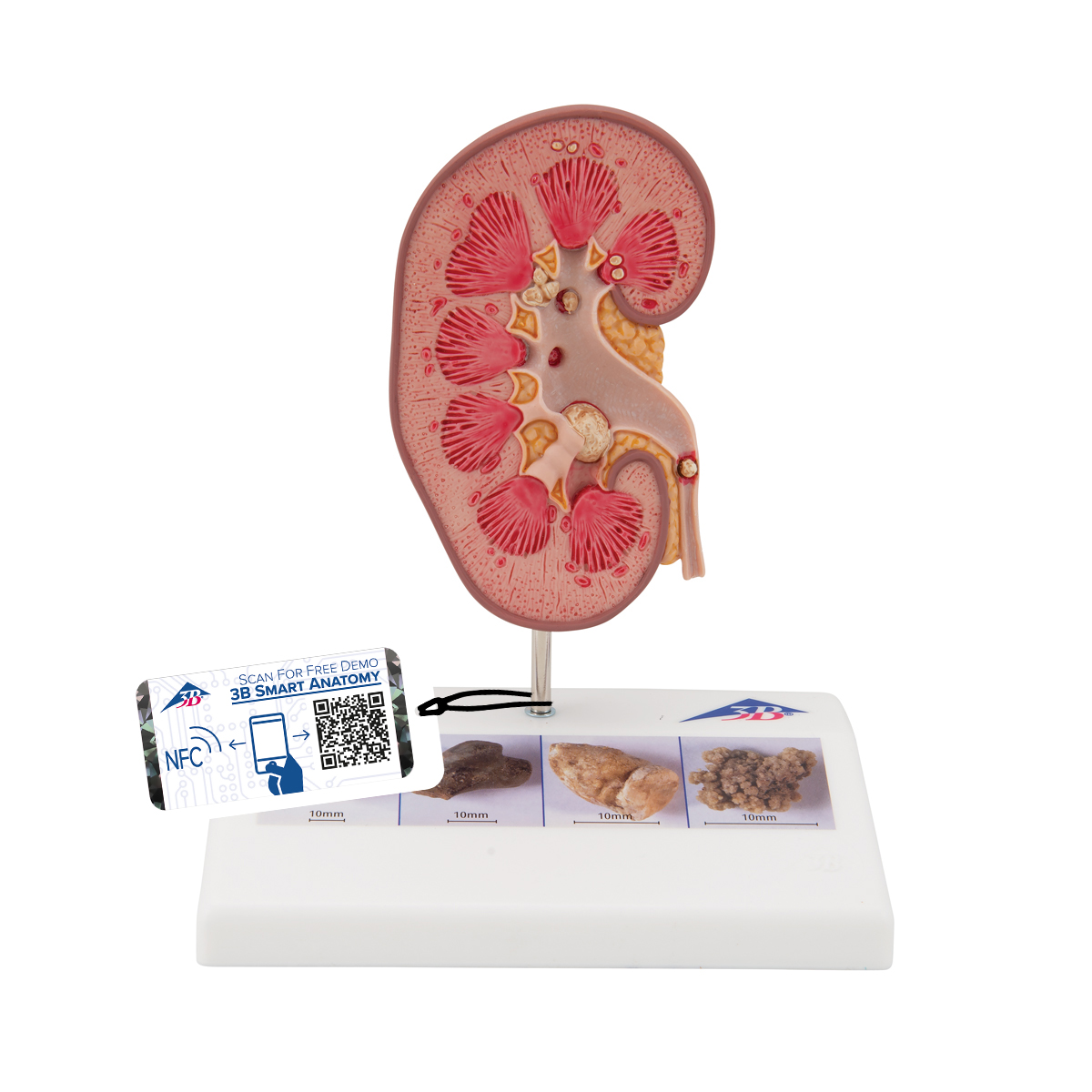 Anatomical Teaching Model Plastic Anatomy Models Renal System Models Kidney Stone Model